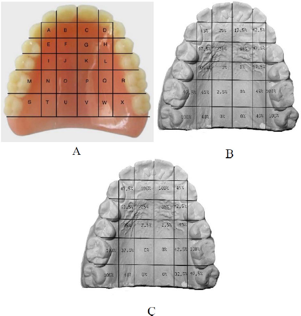 Palatogram Analysis of Complete Upper Denture Adaptation in Producing S and Z Sound: A Cohort Study