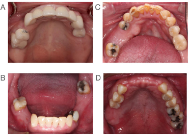 A Retrospective Analysis of Removable Partial Denture Design in Partially Edentulous Patients Attending a Dental Teaching Hospital