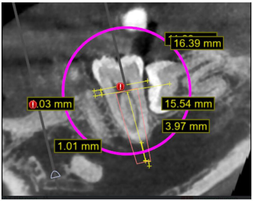 CBCT-based Morphological Assessment of the Mandibular Premolar and Molar Regions for Immediate Implant Placement in Vietnamese Adults: A Preliminary Study