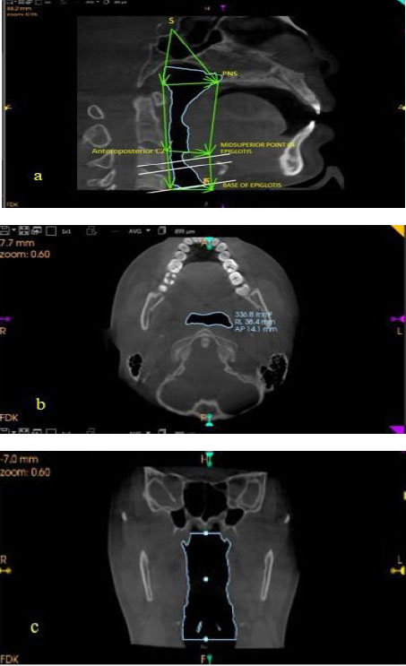 Cone-beam Computed Tomography Evaluation of Upper Airway Morphology and its Association with Age, Gender, and Body Mass Index in Healthy Adults