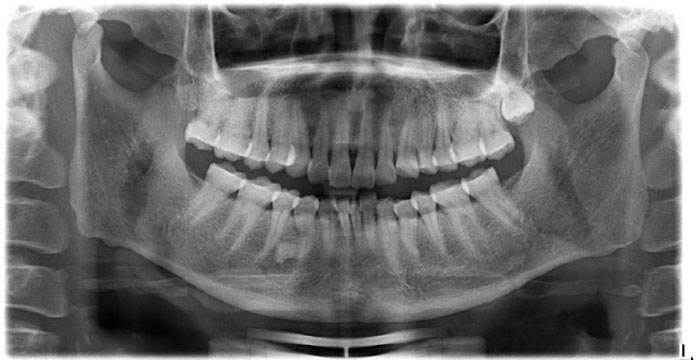 Utilizing Artificial Intelligence to Diagnose Temporomandibular Joint Osteoarthritis Orthopantomographs