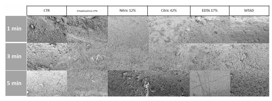 FESEM Analysis of Dentin Cleanliness and Erosion at the Apical Third Level after Treatment with Five Irrigating Solutions: An  Study