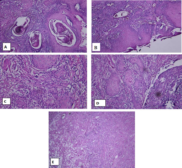 Evaluation of Invasive Front and Depth of Invasion in Oral and Lip Squamous Cell Carcinoma and Clinicopathological Parameters