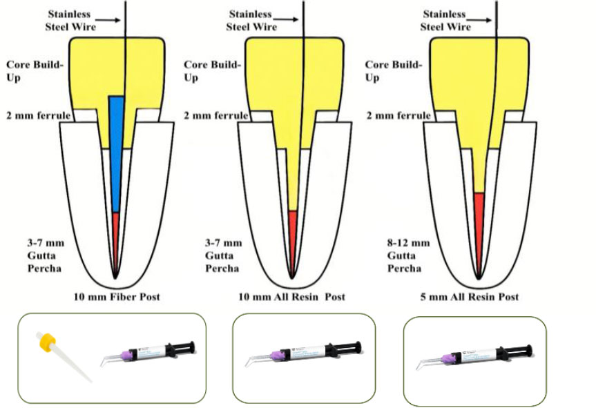 Bond Strength and Failure Modes of Fiber Resin-based Posts with Different Lengths in Endodontically Treated Premolars: An Study
